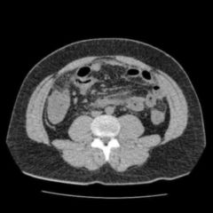 Akutes Abdomen Doccheck Flexikon