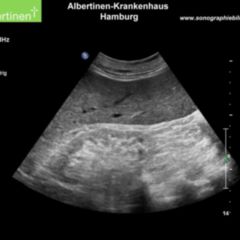 Schrumpfniere DocCheck Flexikon