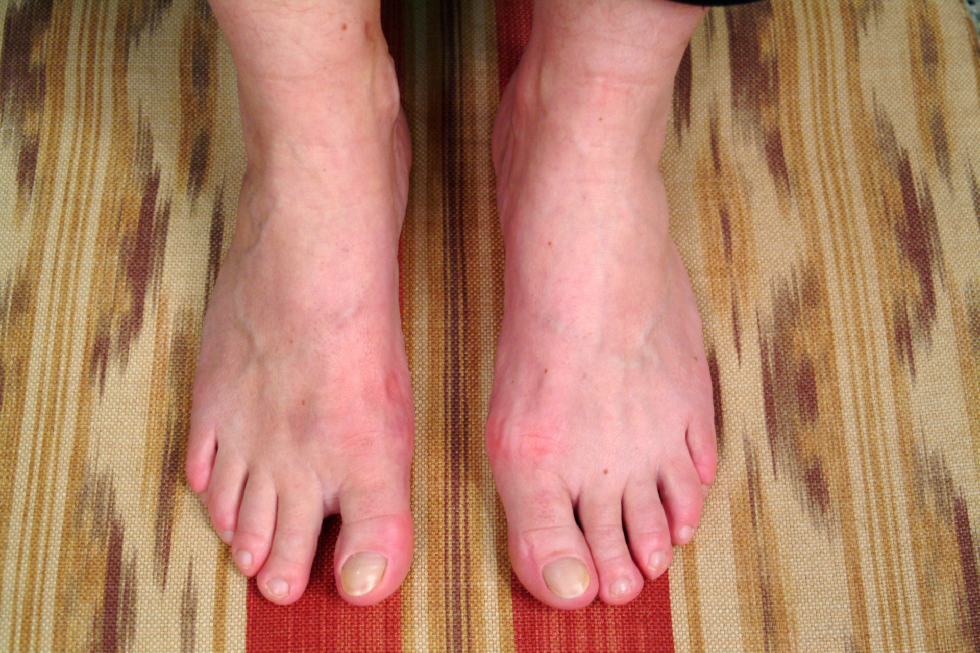 Bunion