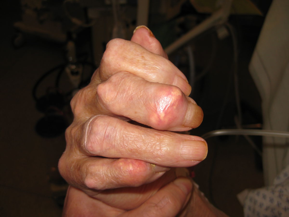 Arthritis urica