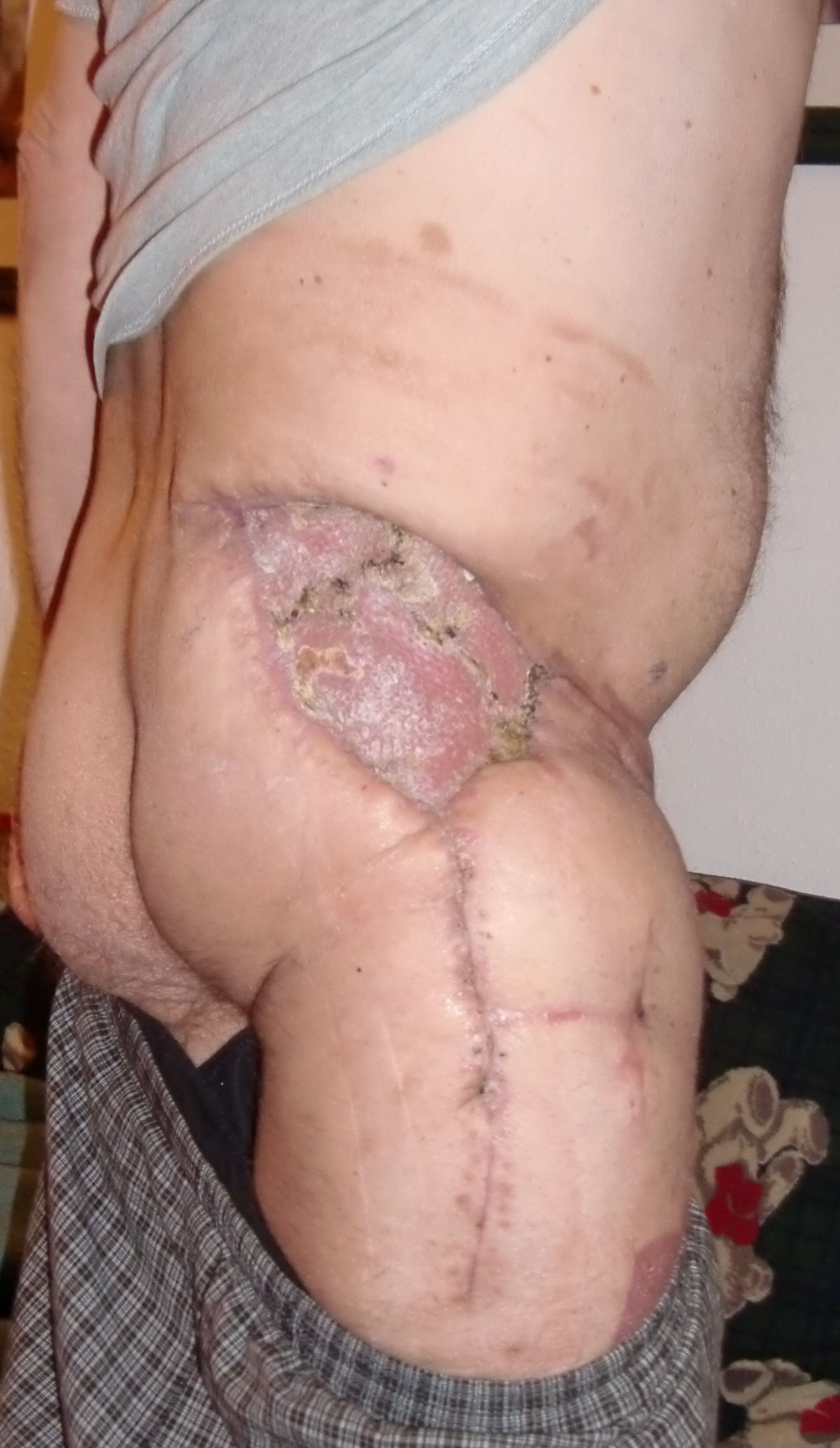 Patients with chondrosarcoma of the end of 2010, findings after operation in 10/2010 UK MS Orthopedics / Oncology