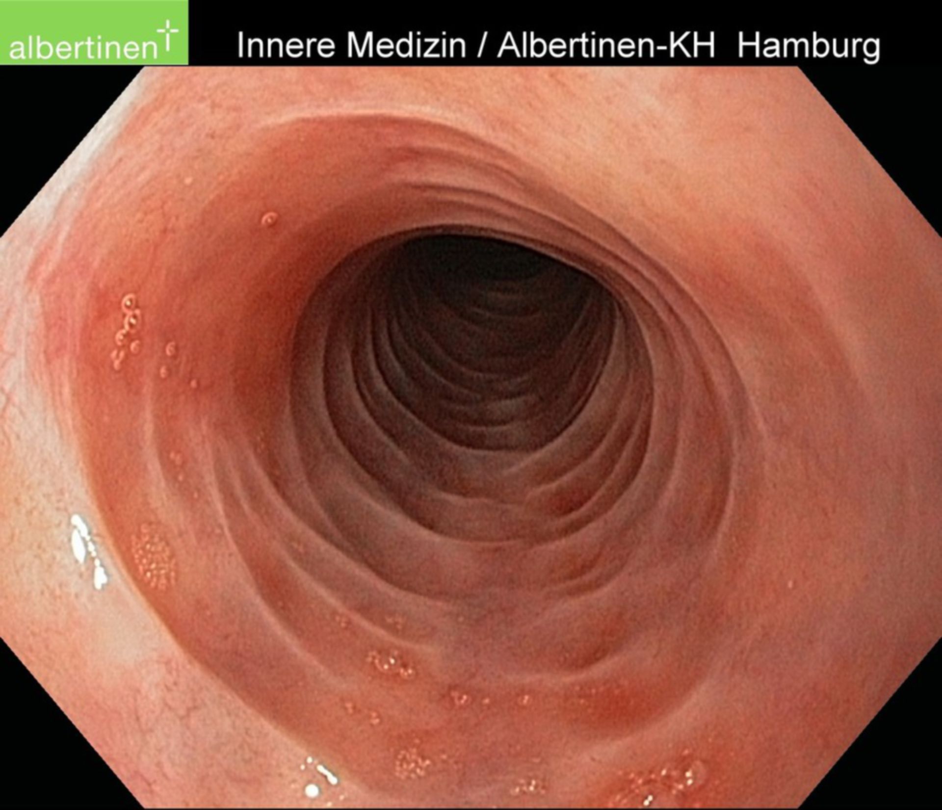 Eosinophilic Esophagitis