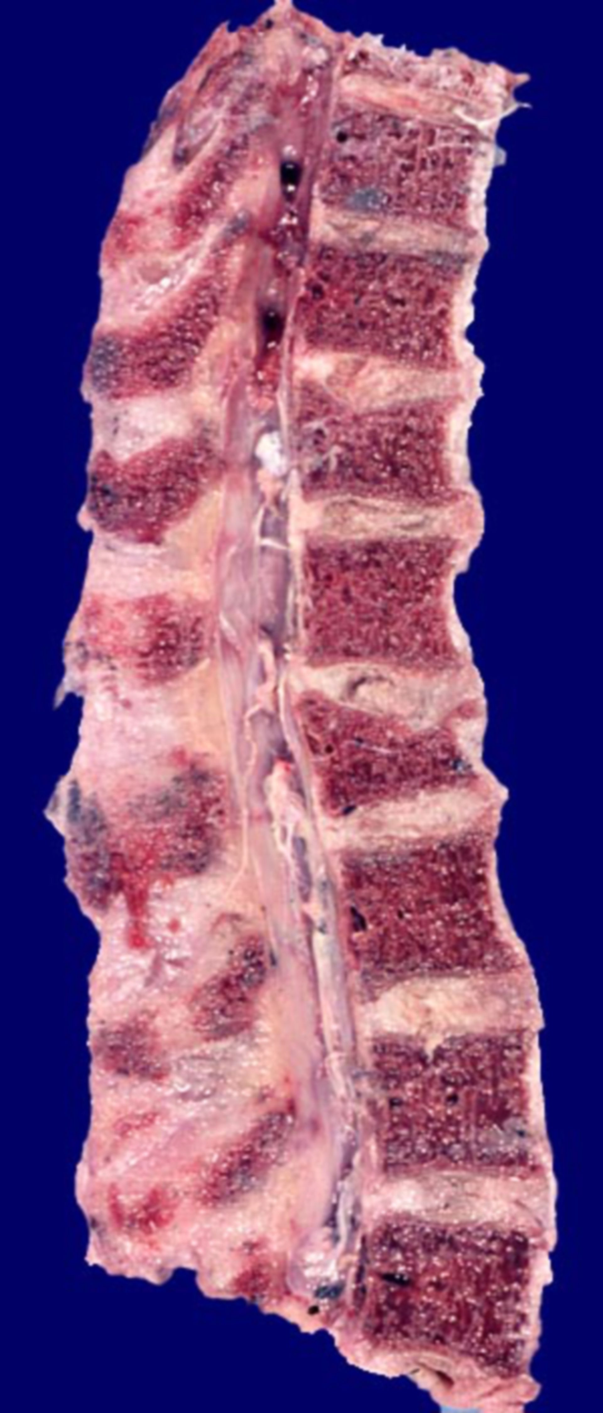 Compression fracture of vertebral body due to osteoporosis