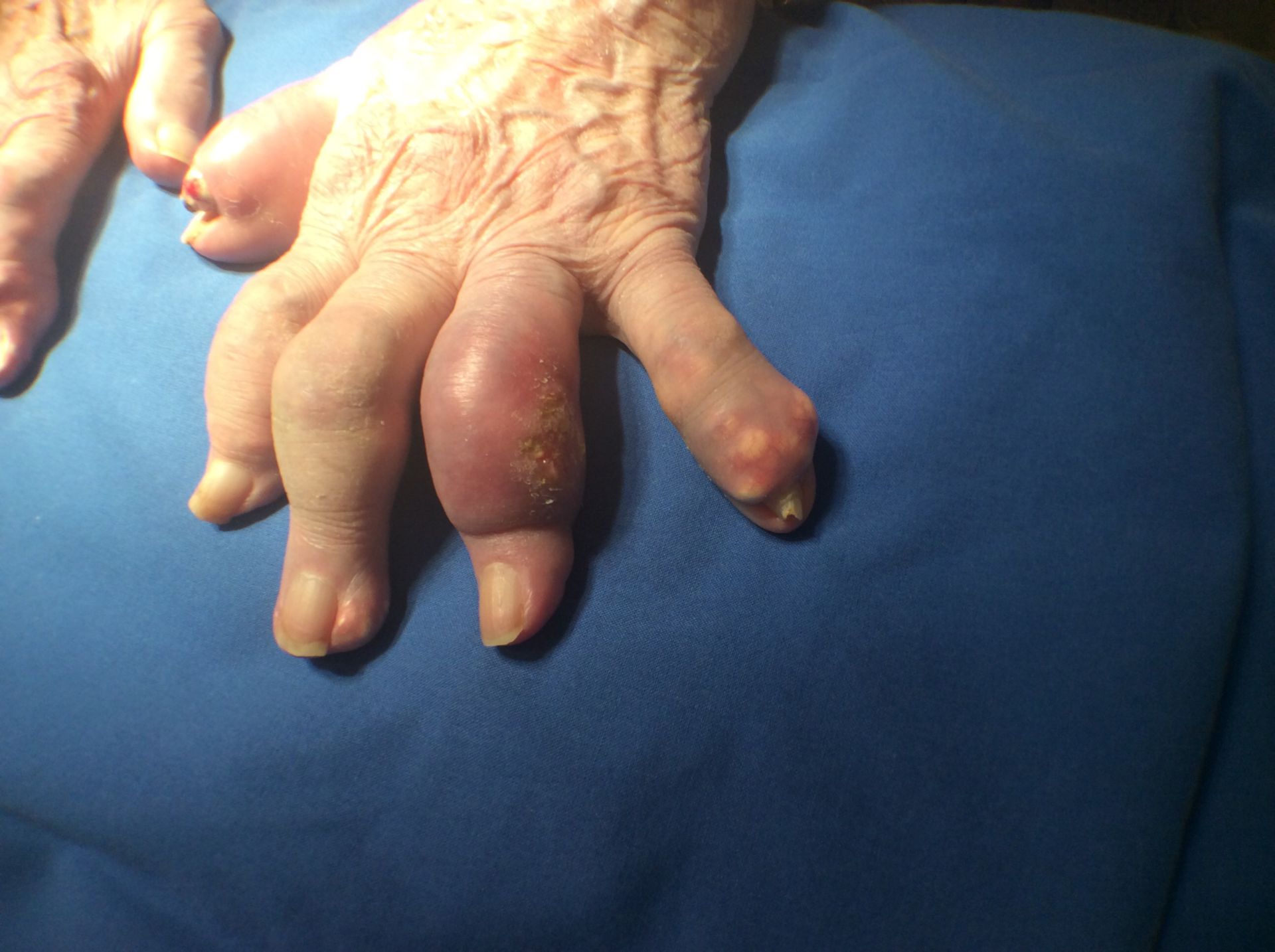 Arthritis urica- Gichttophi