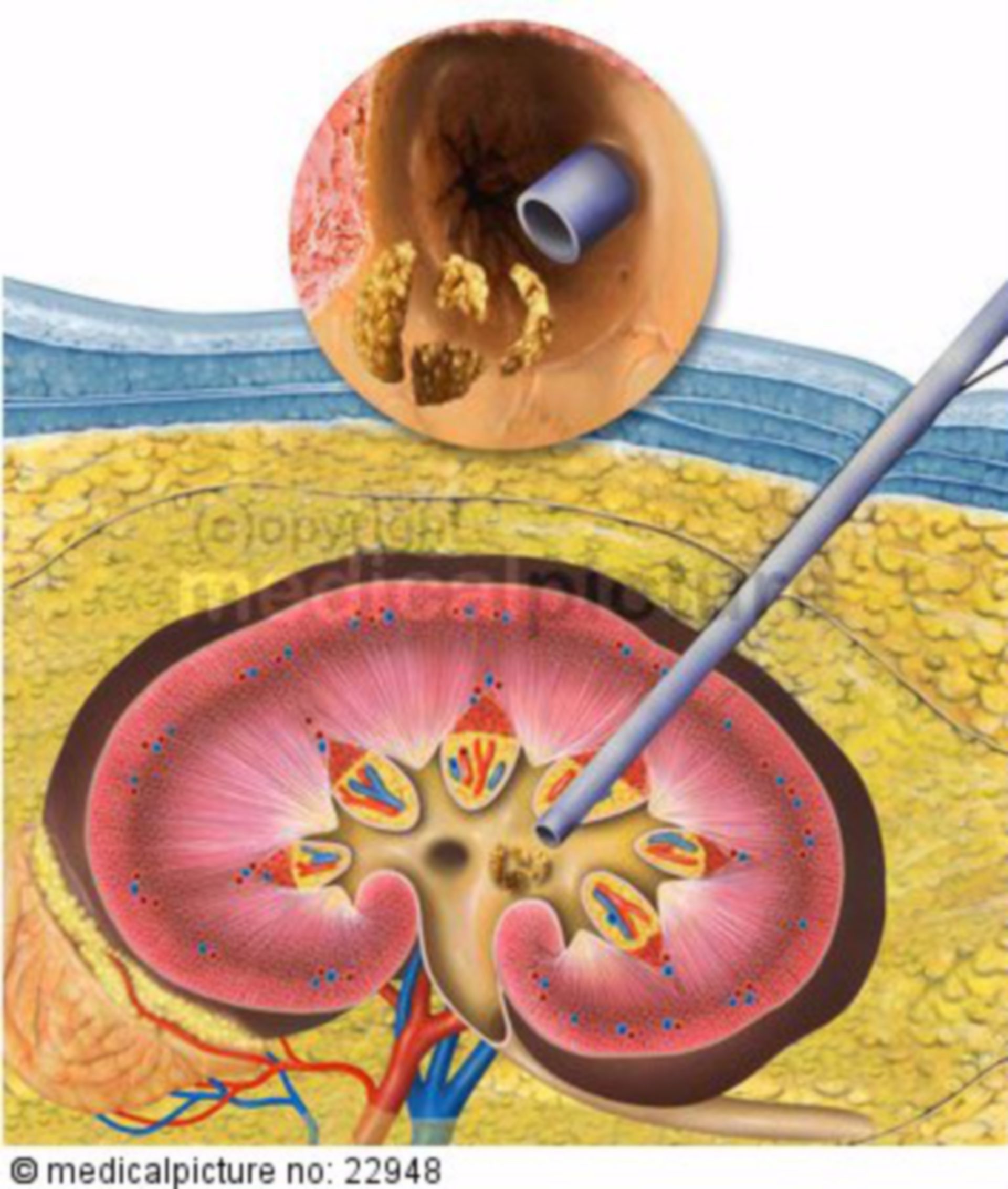 Kidney stone destruction in case of nephrolithiasis, kidney