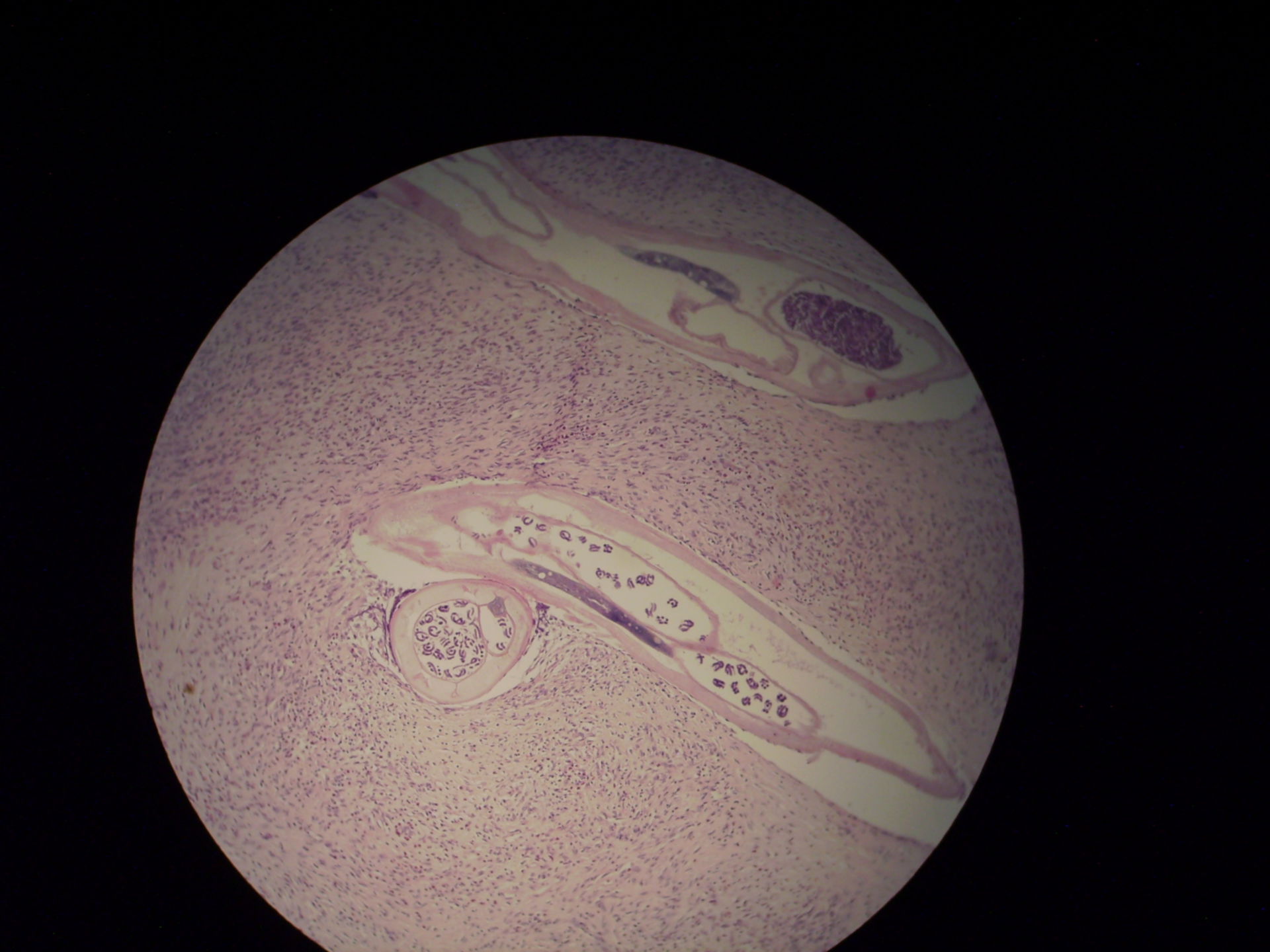 Oncocercosi microfilaria