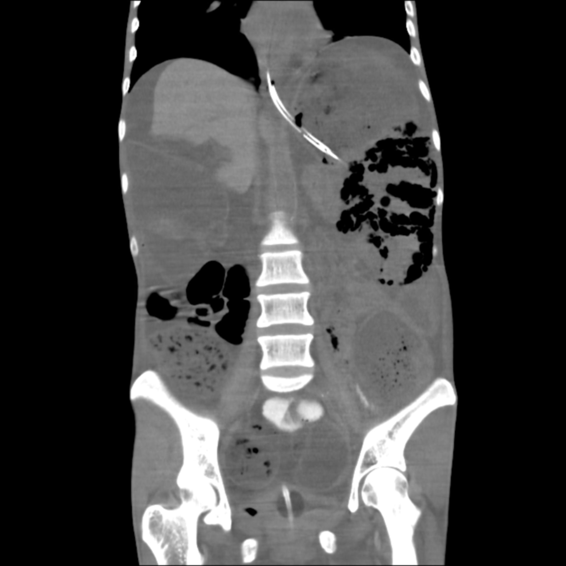 cor300001: CT des Abdomens in frontaler Ebene