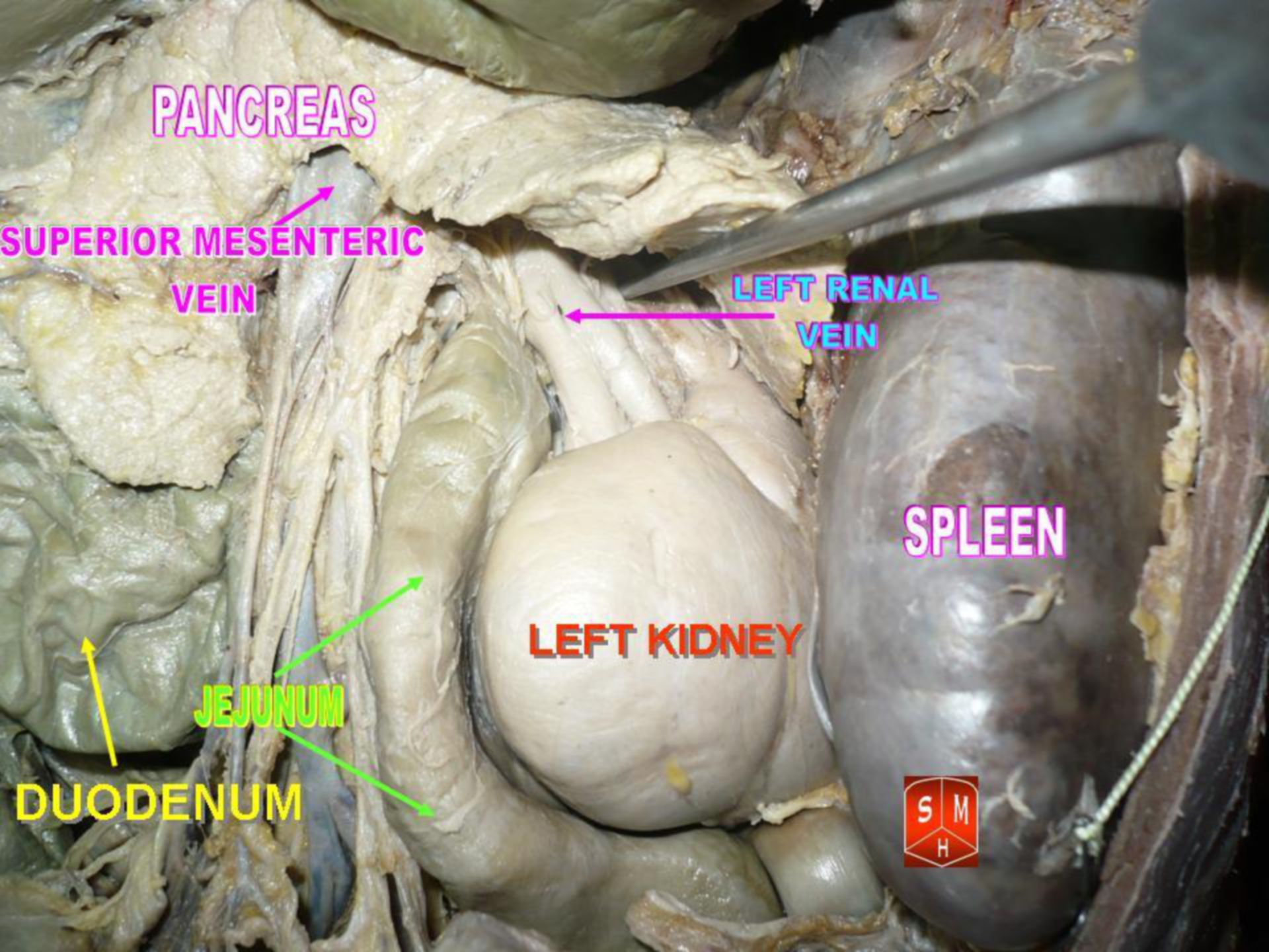 Left kidney (marked in red)