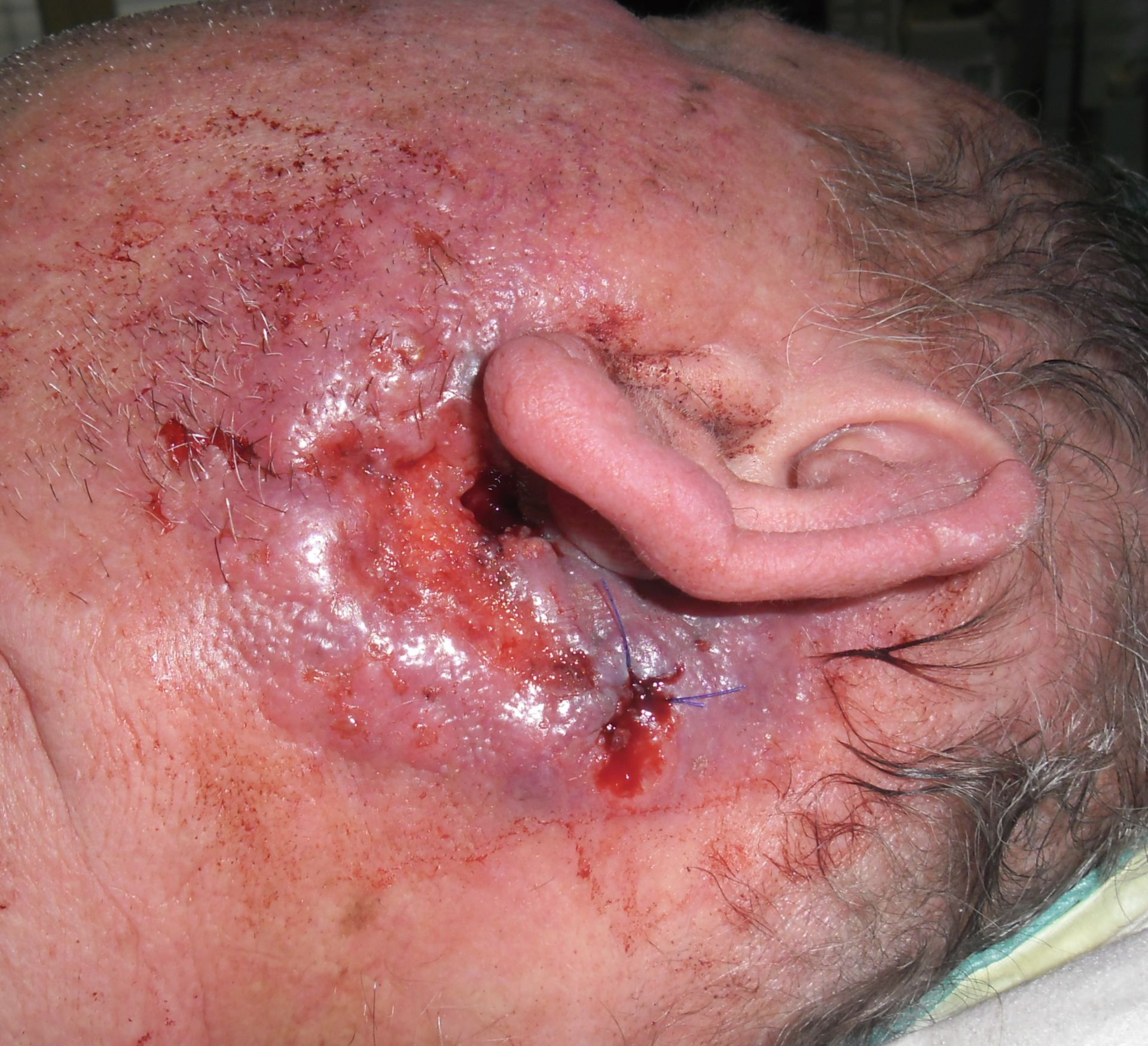 Carcinoma a cellule squamose retroauricolare