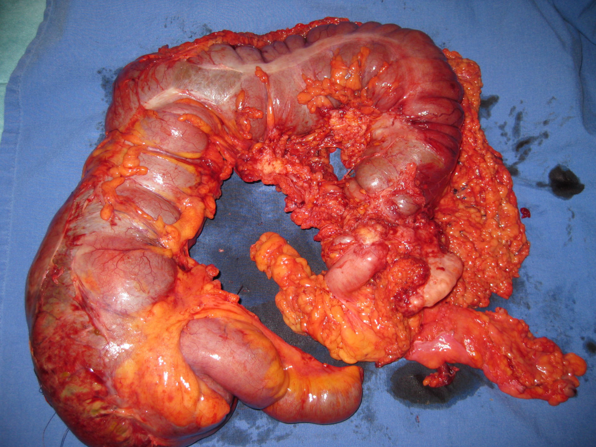 Resected portion of the colon