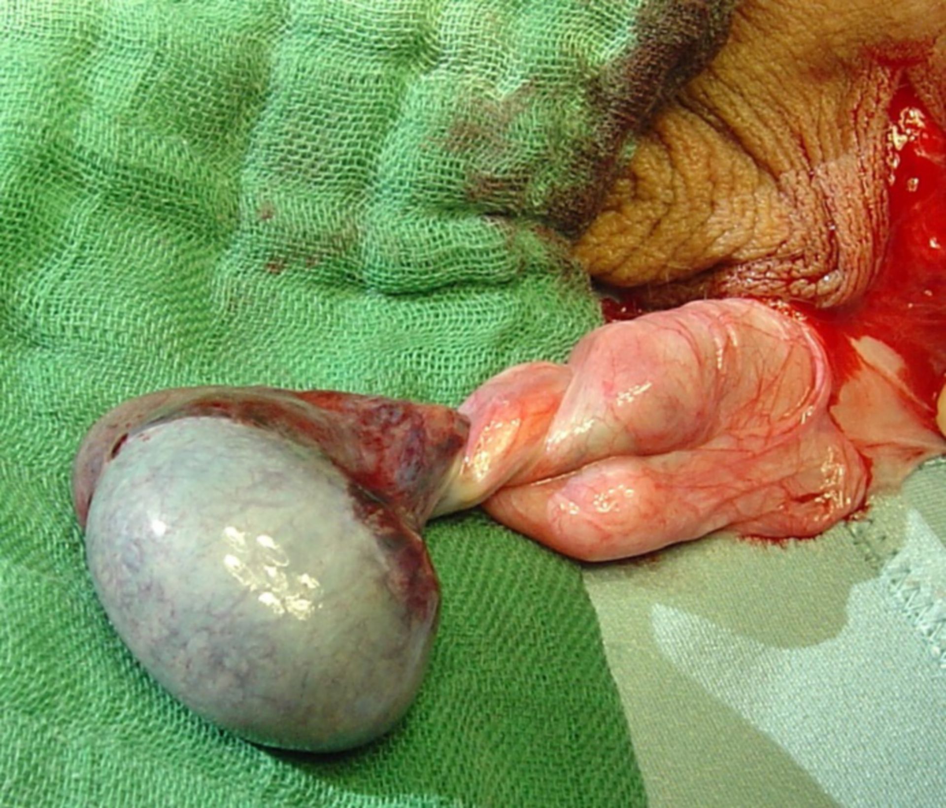 Intraoperative finding of a testicular torsion