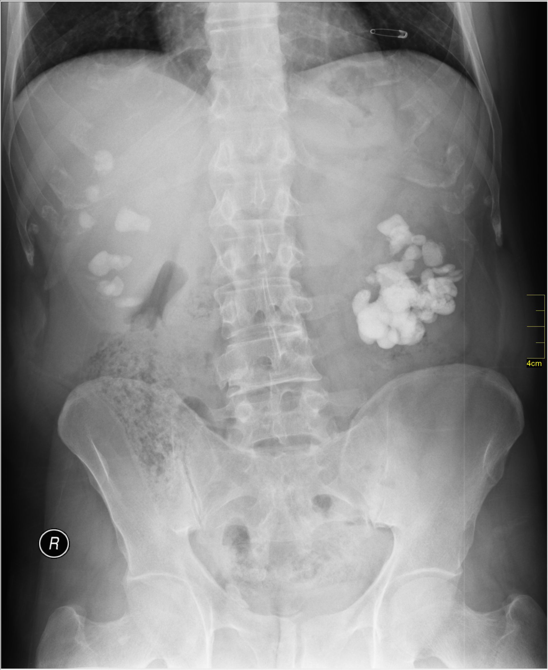 X-ray with bilateral Kidney stones