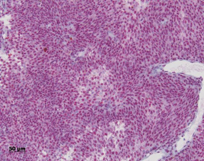 Linkes Bild zeigt eine sehr starke Färbung der Tumorzellen. ©Arbeitsgruppe Dr. M. Zeschnigk