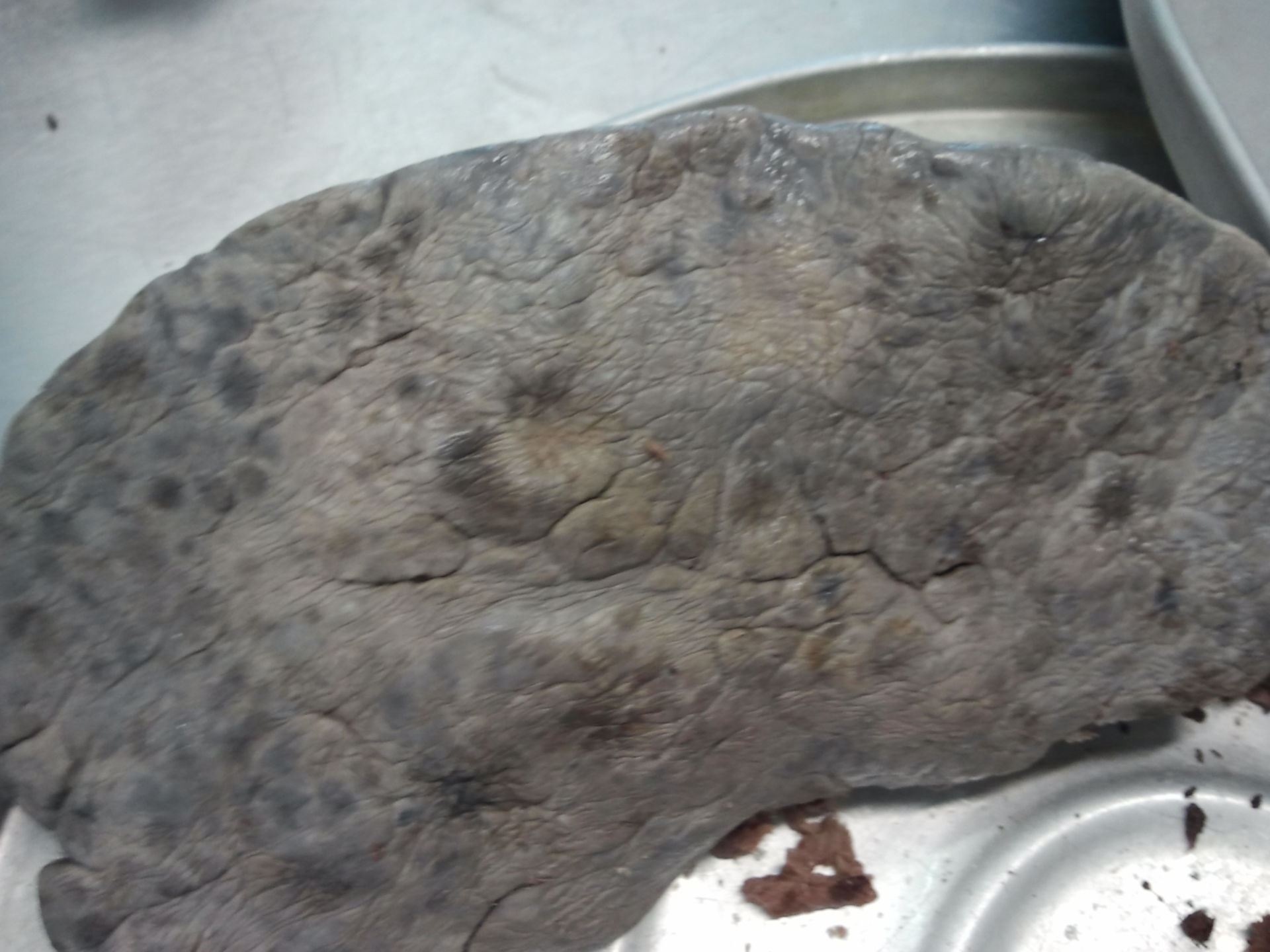 Liver with metastases