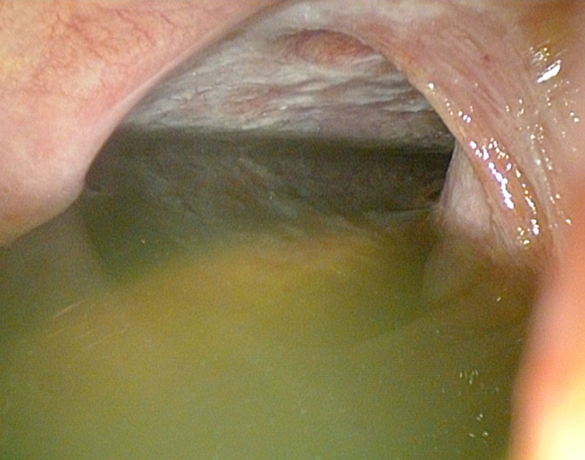 Ascites bei Peritonealcarzinose - Laparoskopie: CUP