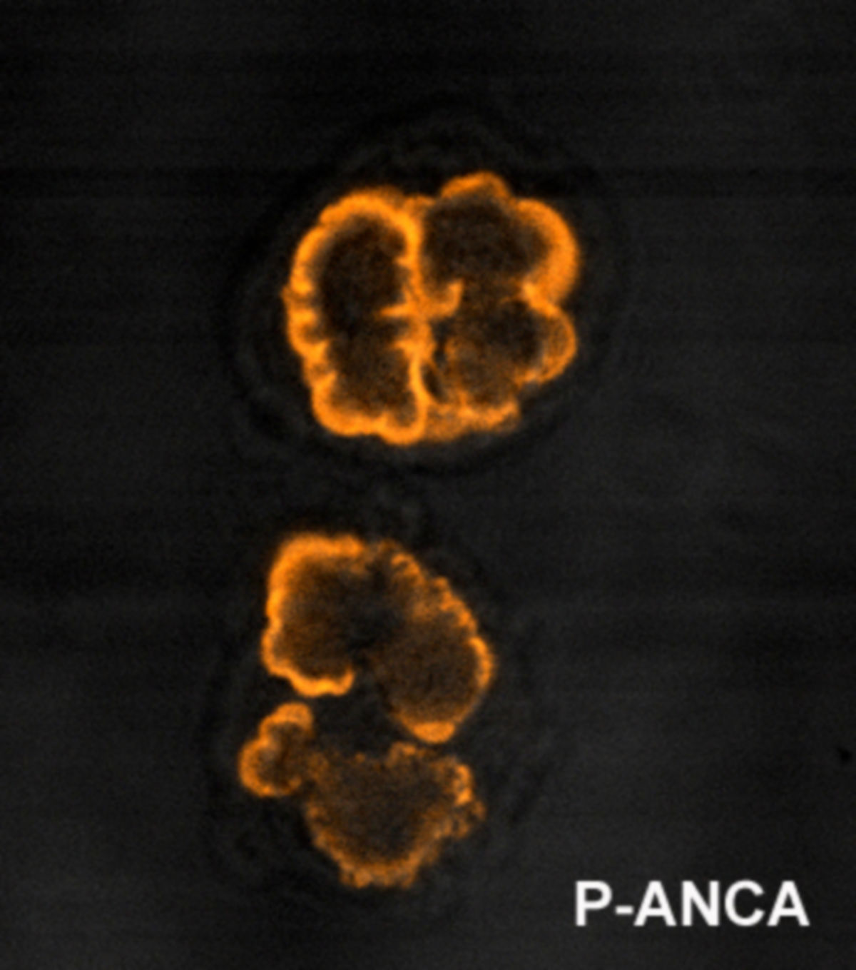 p-ANCA mit typischer perinukleärer Anfärbung
