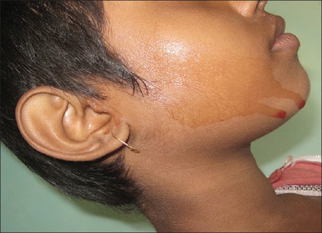 Hematohidrosis-Indian-Journal-Dermatology-Dermatol-2013-58-6-478-119964-f1