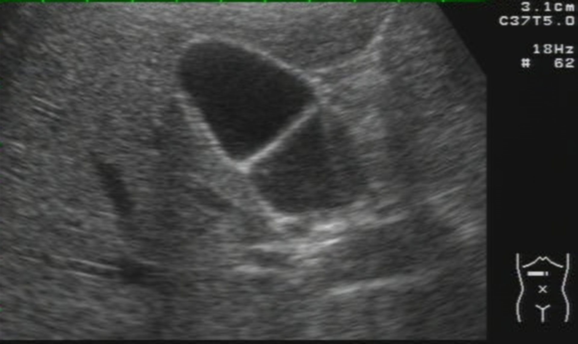 Gallbladder septum