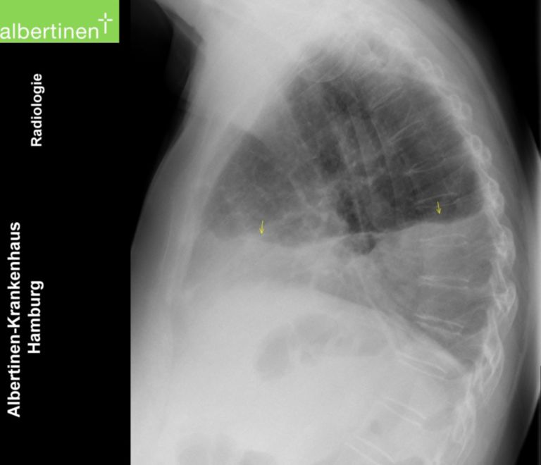 pleural effusion x ray lateral