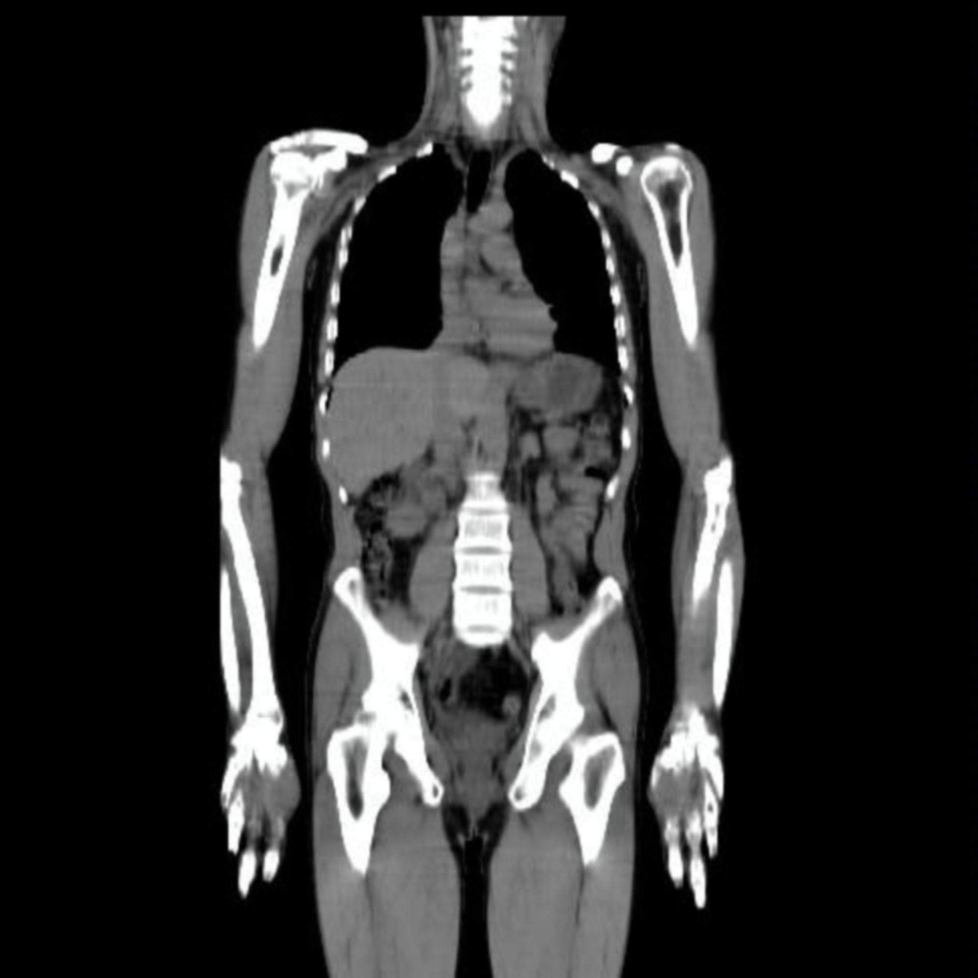 CT scan