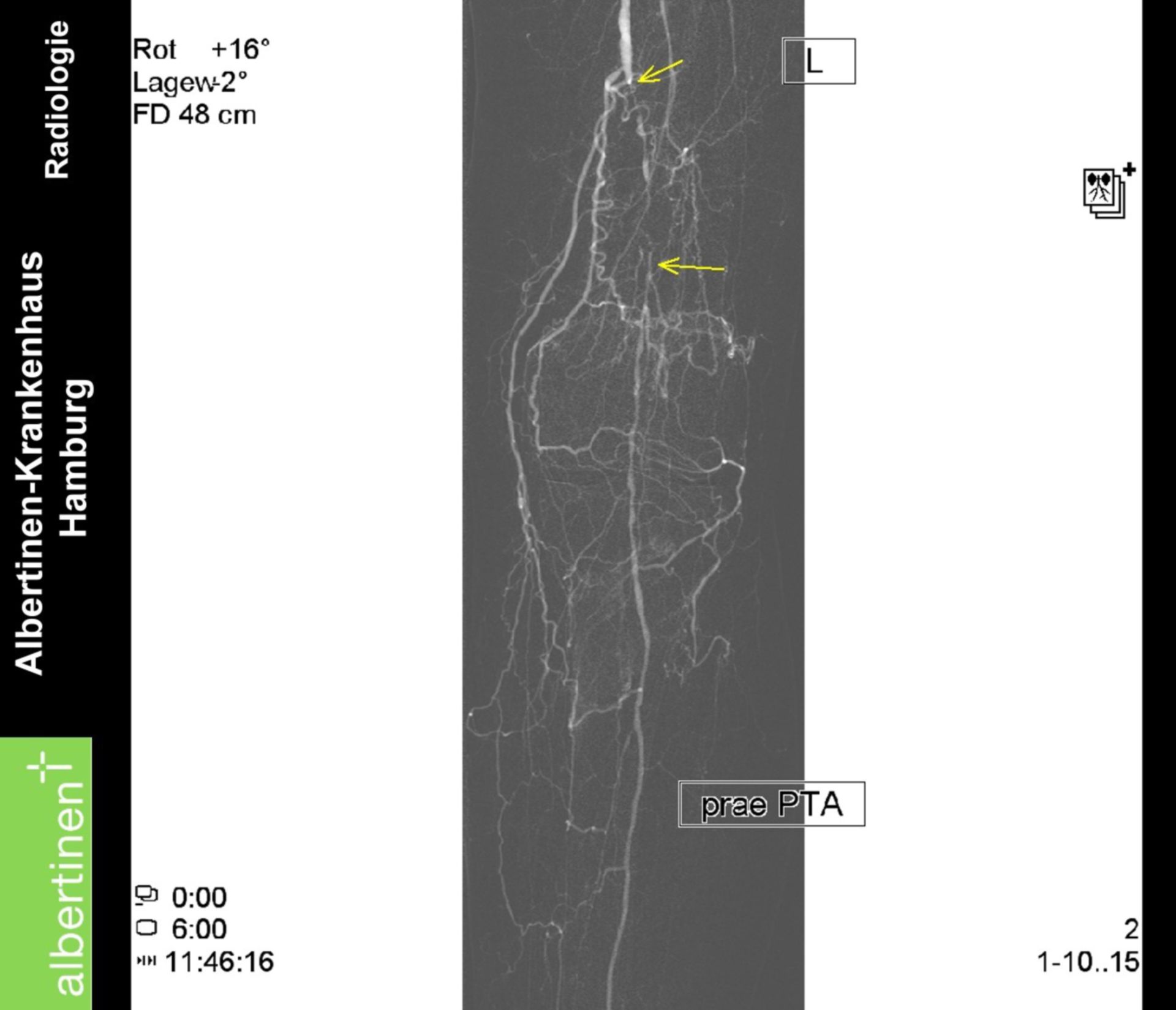 Distal occlusion of the femoral superficial artery before PTA