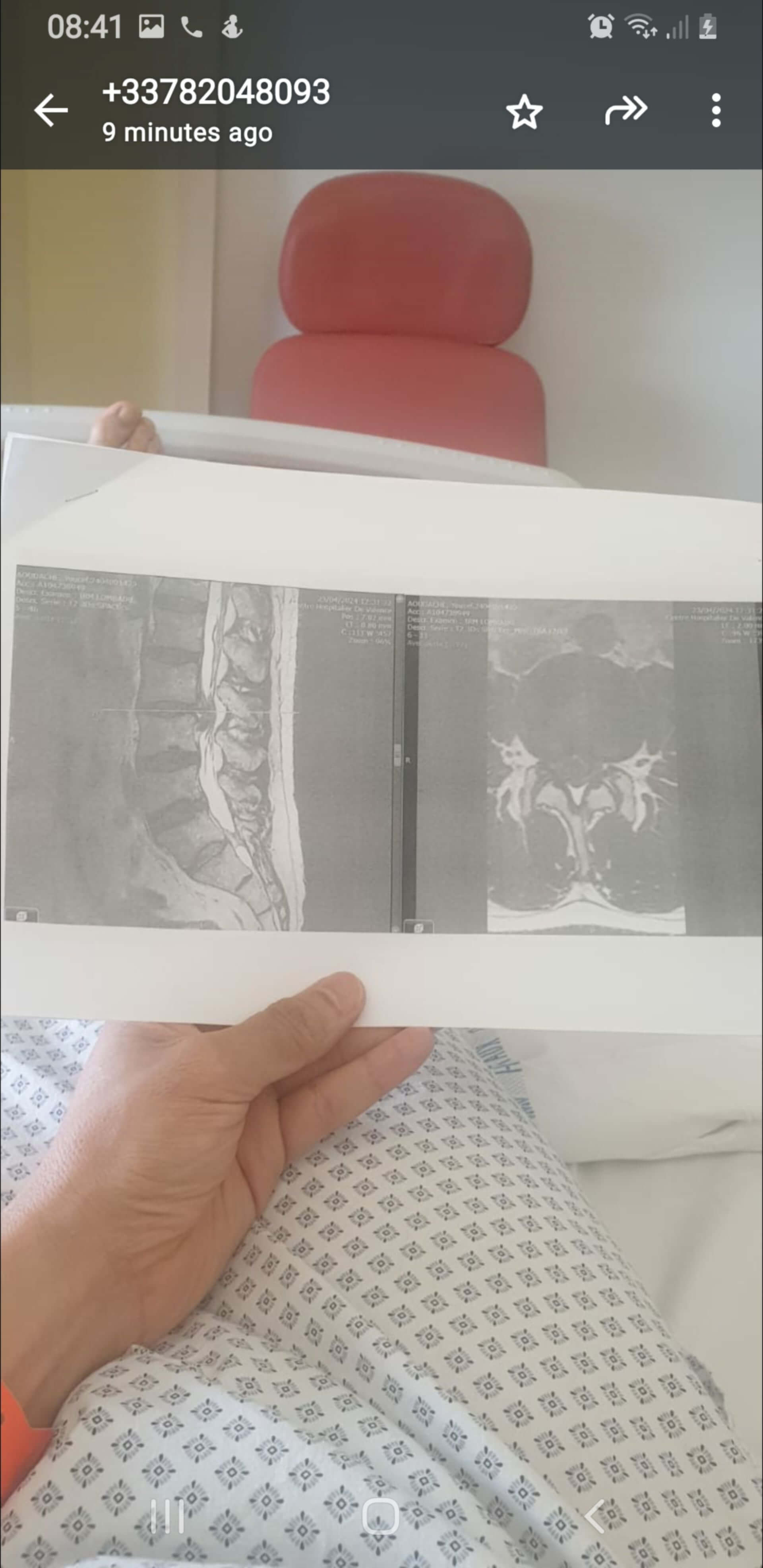 I had this MRI
