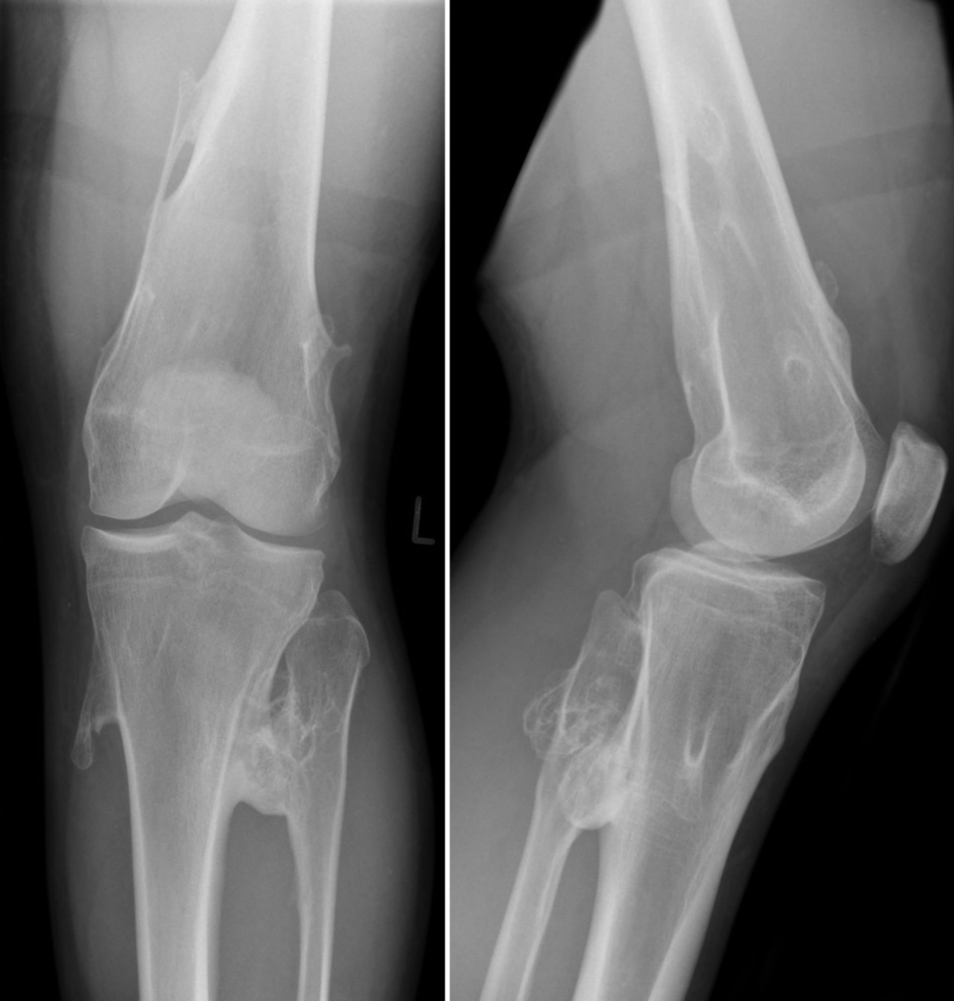 Hereditary exostoses (left knee)