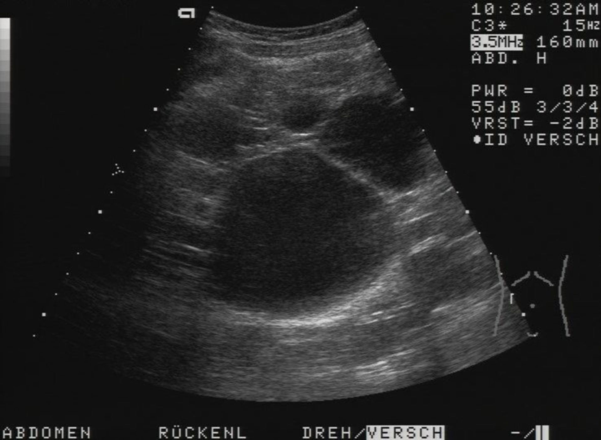 Liver cyst