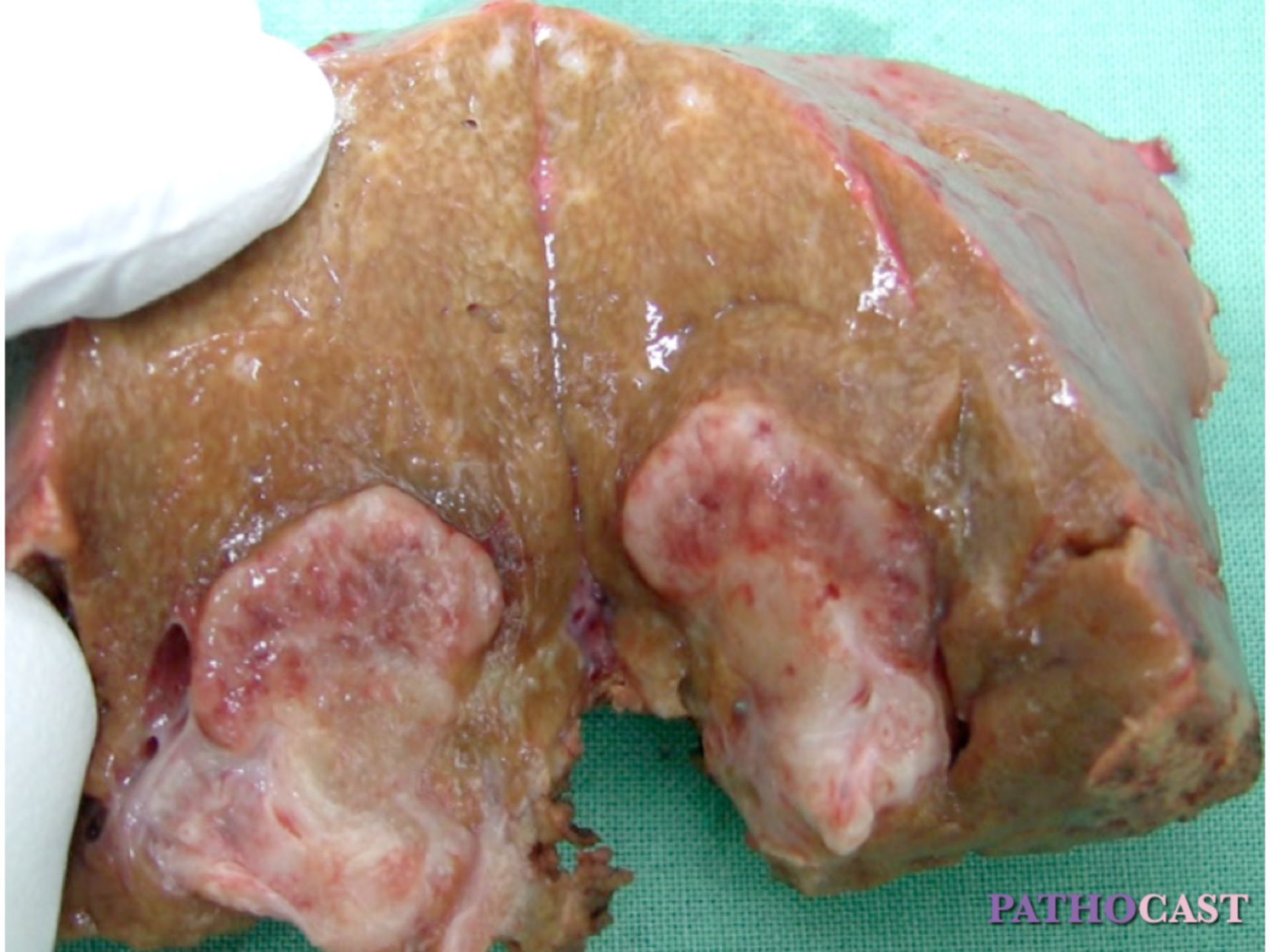 Liver Metastasis of a Colon Carcinoma (Macro)