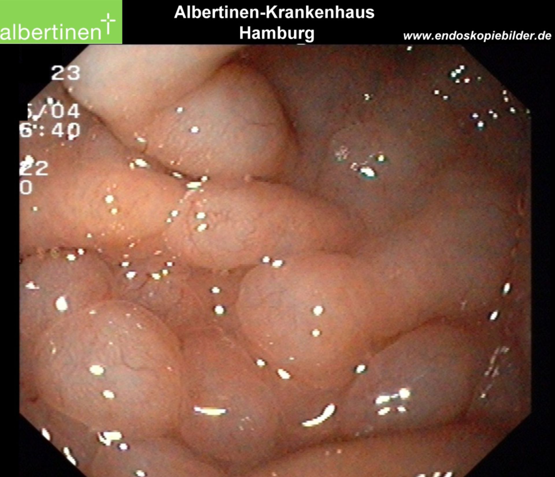 Mantle cell lymphoma with manifestation close to the stomach