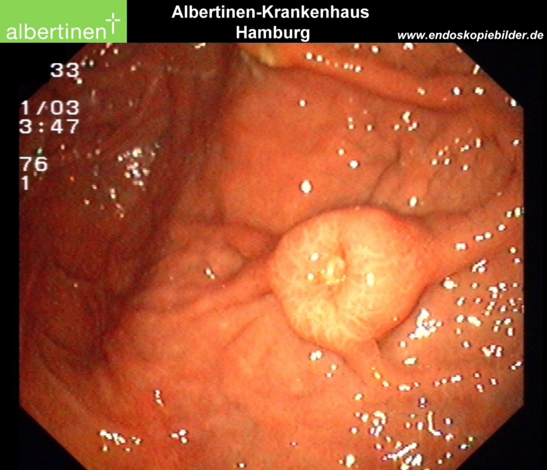 Endoscopy: GIST in the stomach