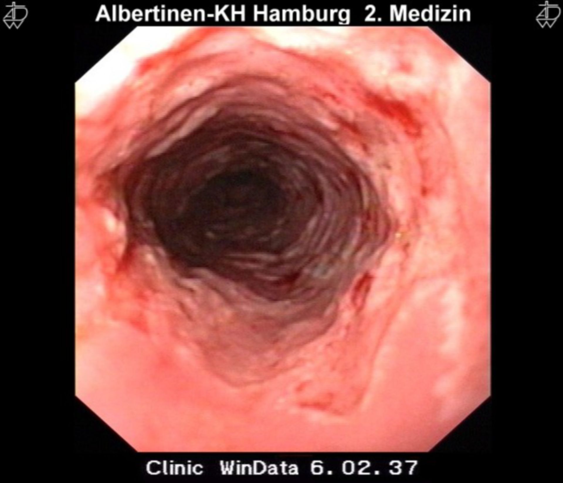 CMV-Oesophagitis