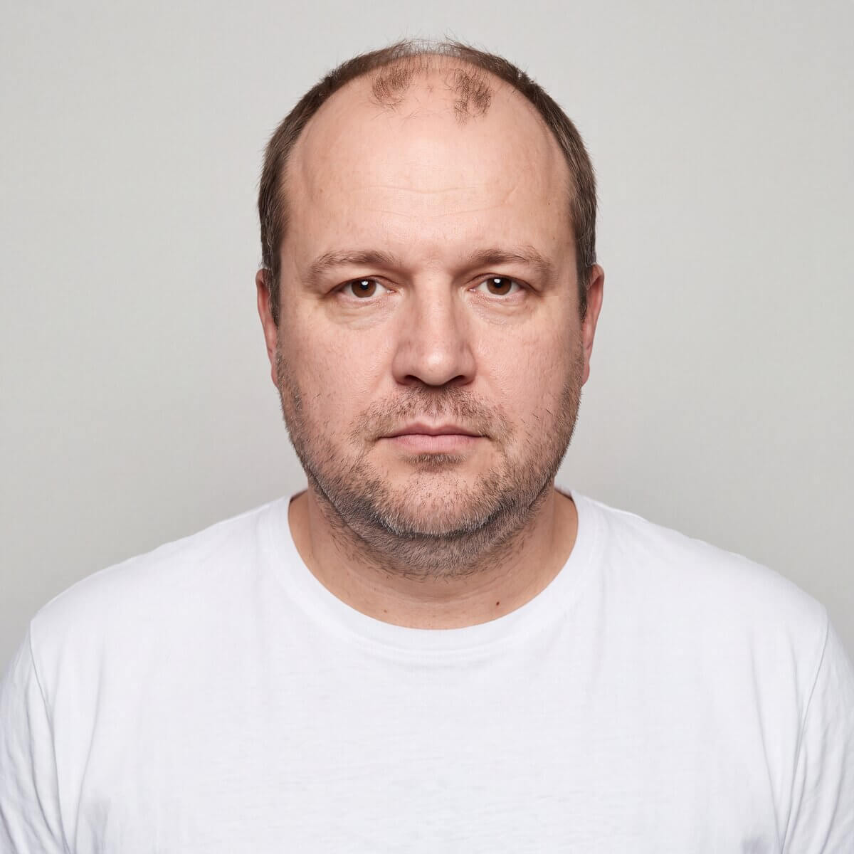 Androgenetische Alopezie