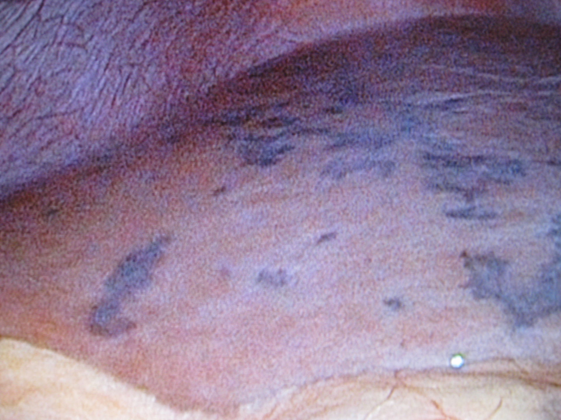 Hämangiom - multiple Hämangiome bei einem 14 jährigen Mädchen in beiden Leberlappen
