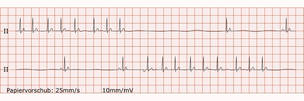 Rhythmusstreifen bei Tachykardie-Bradykardie-Syndrom (Sick-Sinus-Syndrom)