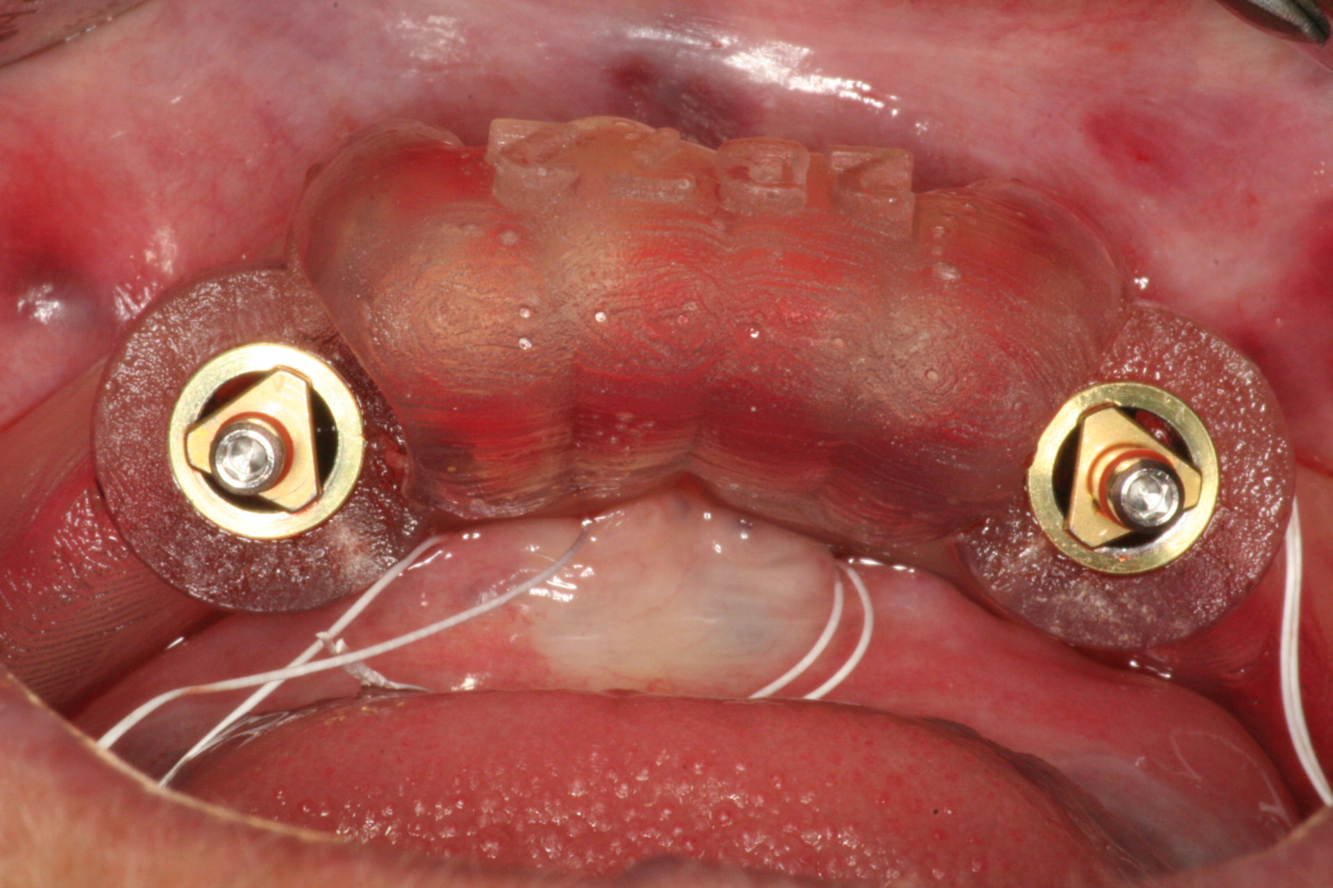 3D Guided Implant Placement