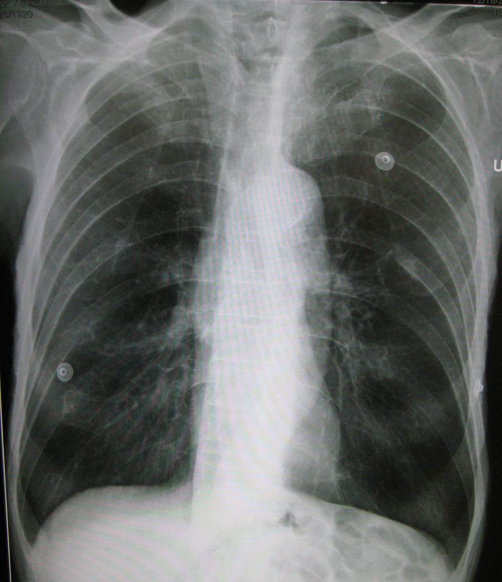 emphysem: Röntgen des Thorax von a.p.