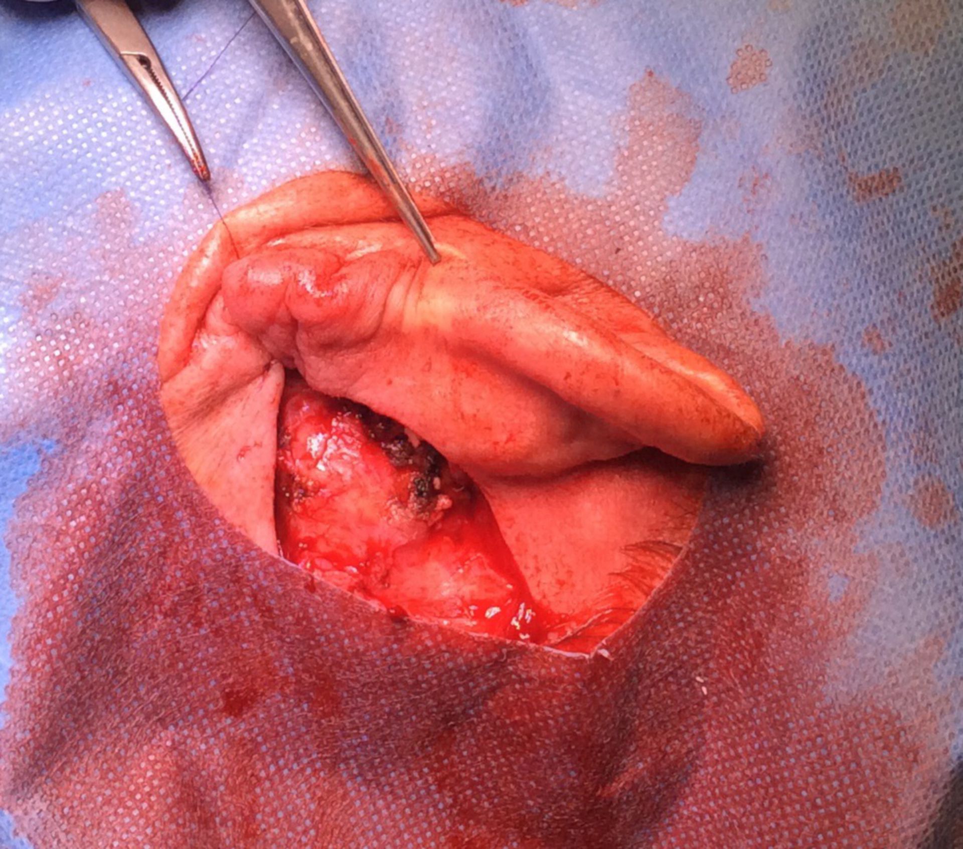 Retroauricular basal-cell carcinoma: intraoperative site