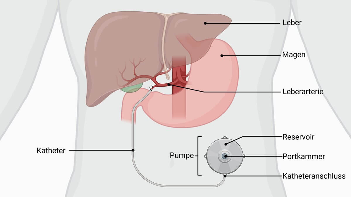 Implantierbare Infusionspumpe
