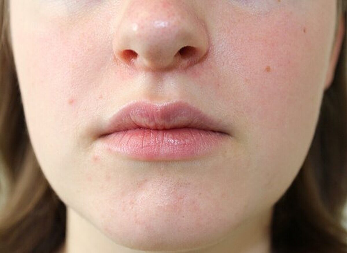 Periorale Dermatitis