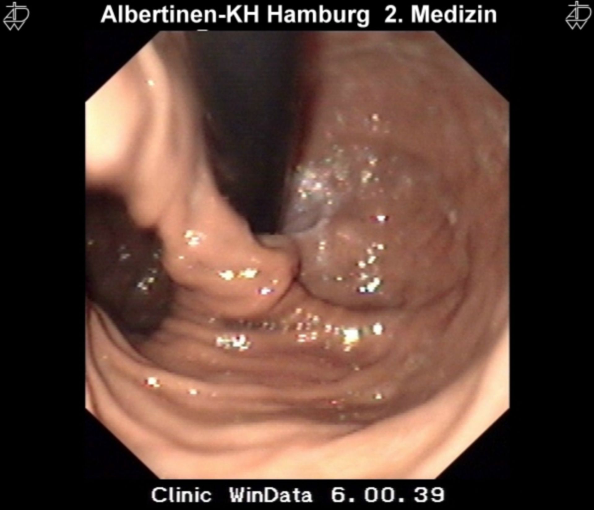 Paraesophagal hernia