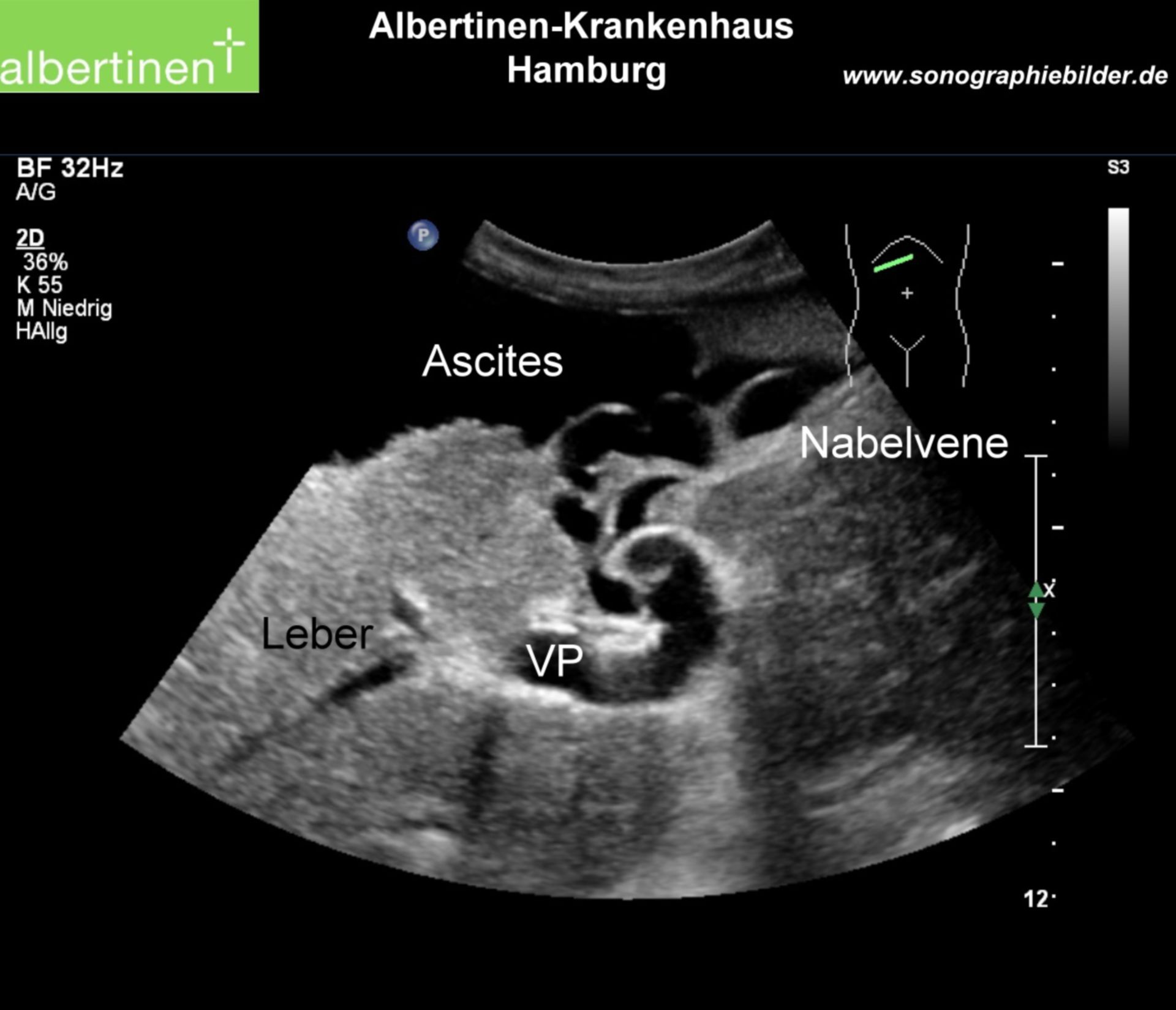 Cruveilhier-Baumgarten, liver sonography