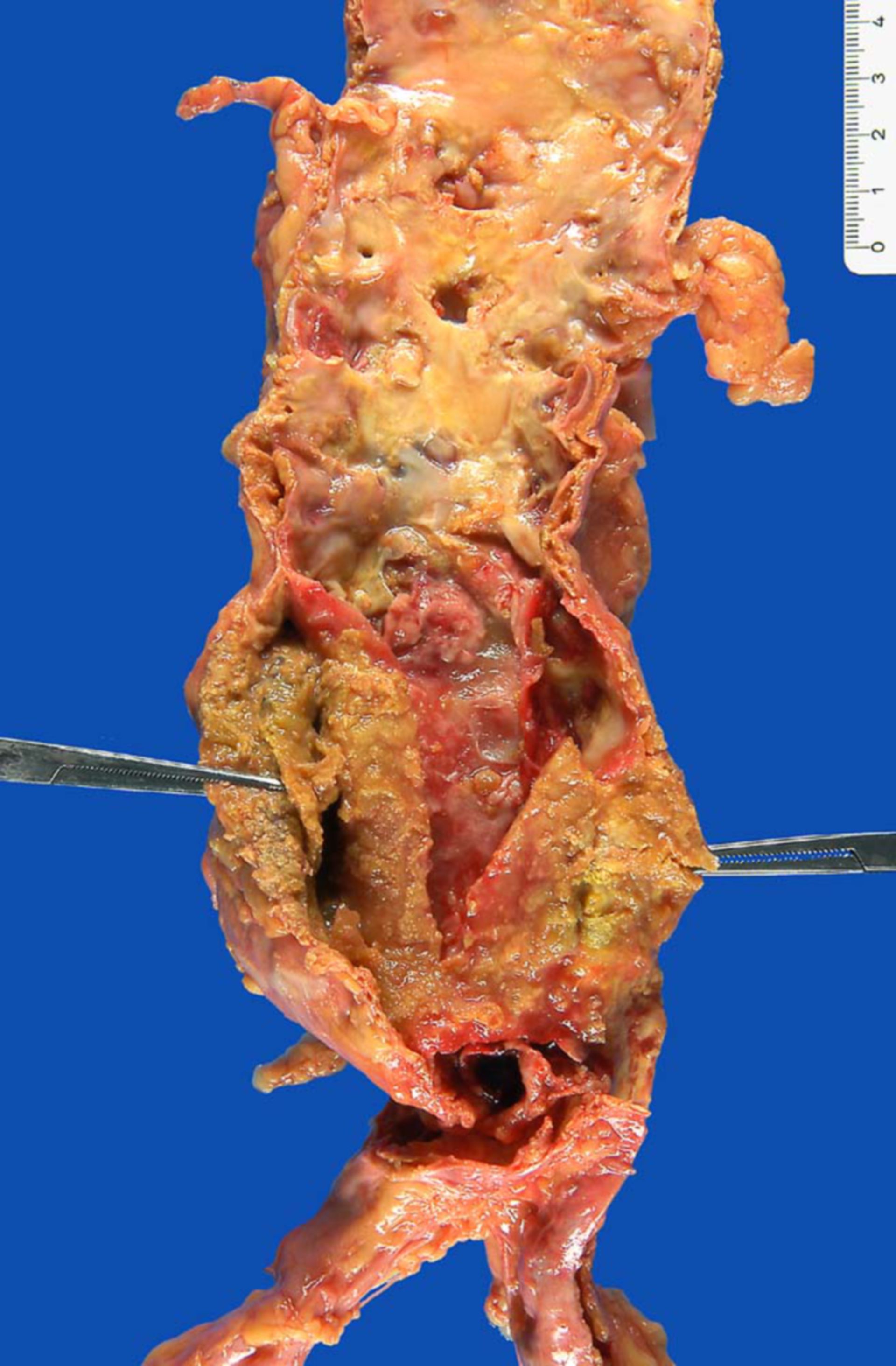 Infrarenal aortic aneurysm