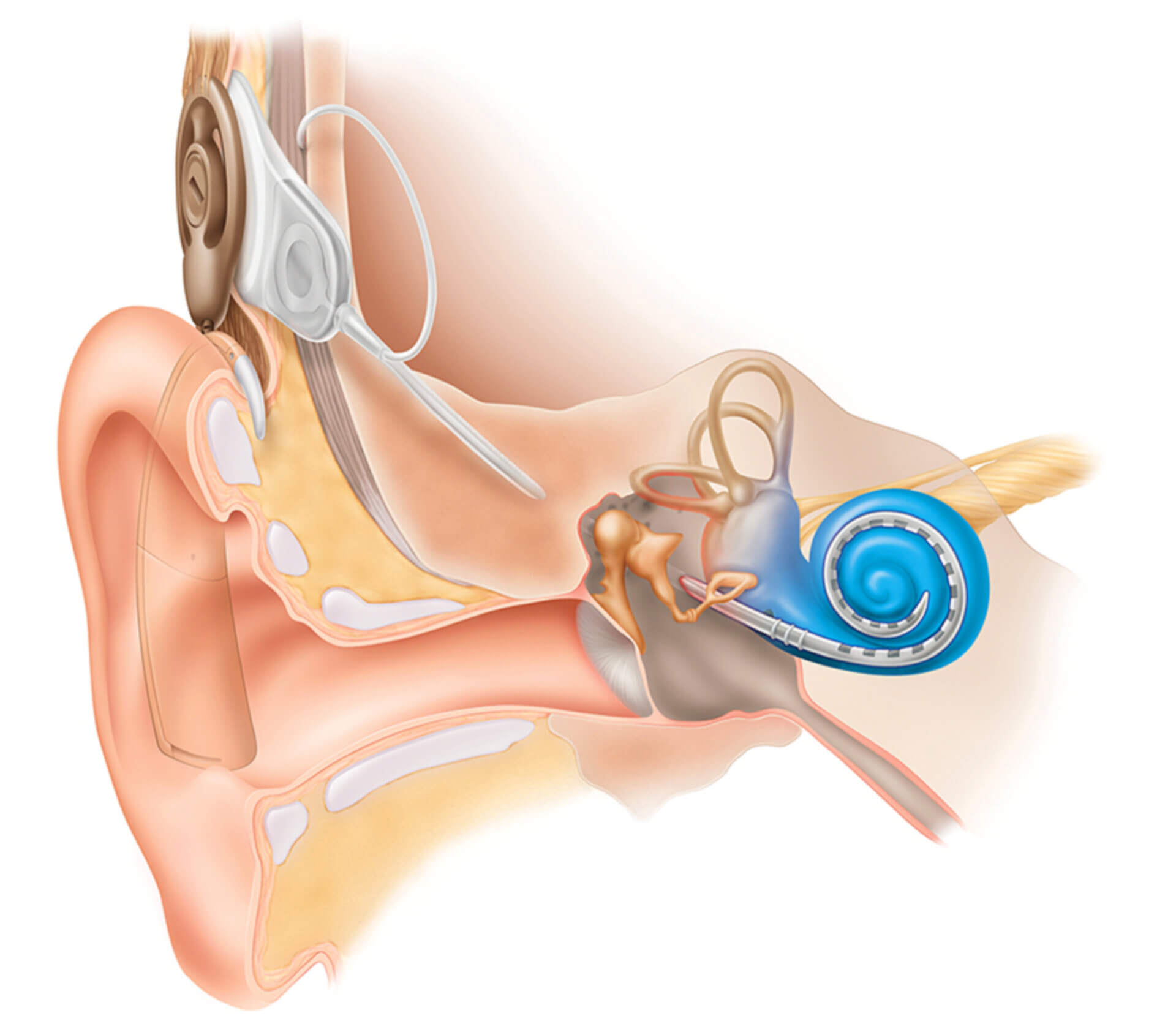 Cochlea-Implantat