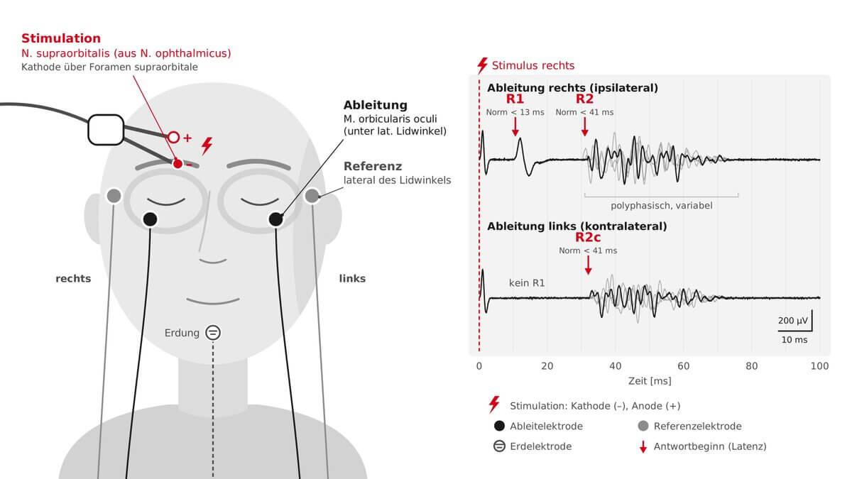 Blinkreflex-Untersuchung – Ableitung und Normalbefund