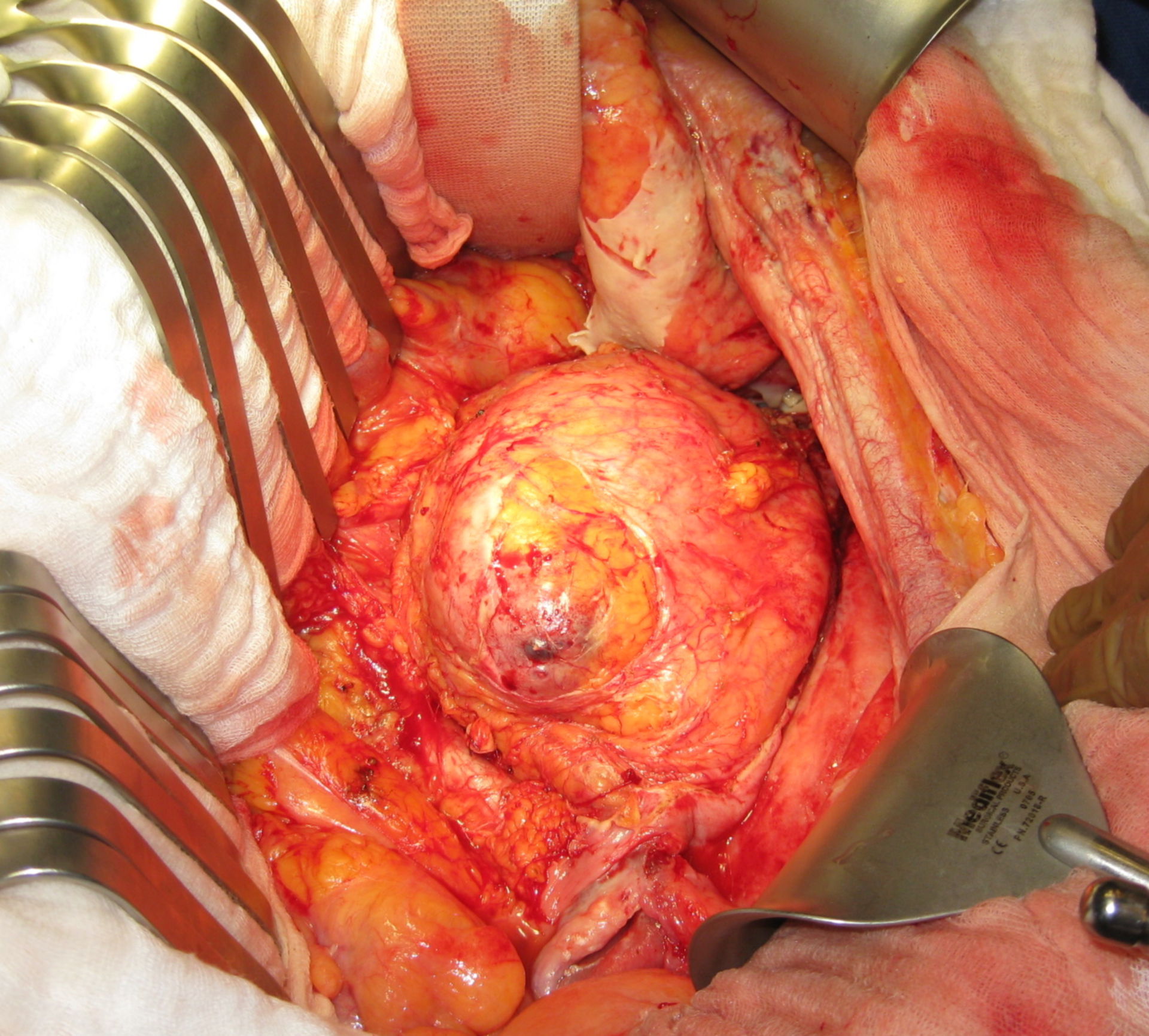 Pionefrosis- imagen tomada durante la cirugía