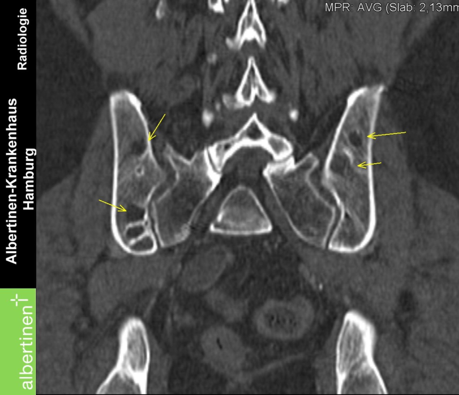Becken-Osteolysen Plasmozytom coronar CT