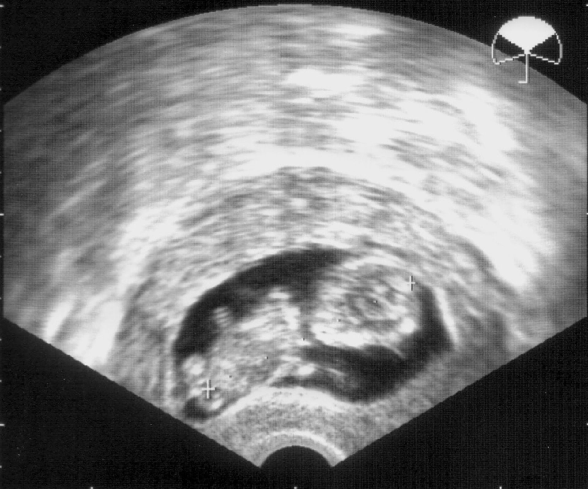 Ultrasound image - 12 weeks pregnant