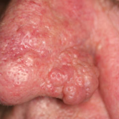 Rhinophym DocCheck Flexikon