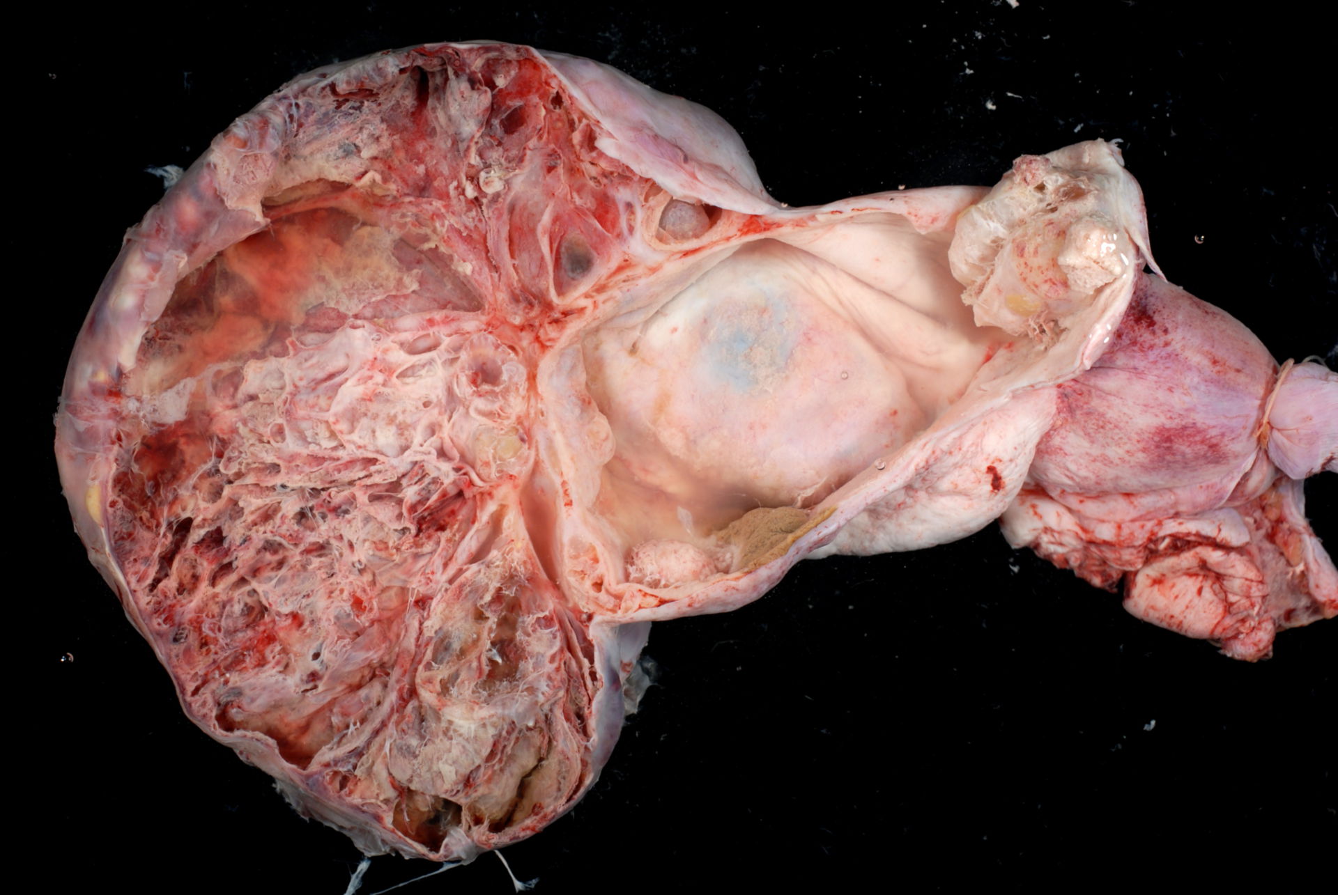 Multizystischer Tumor des Ovars
